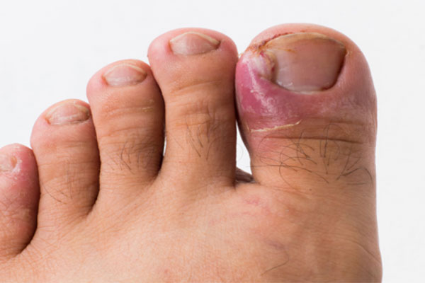 برای کشیدن ناخن به چه دکتری مراجعه کنیم 1